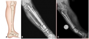 手术技巧：Ilizarov骨搬运技术和髓内钉治疗胫骨骨不连