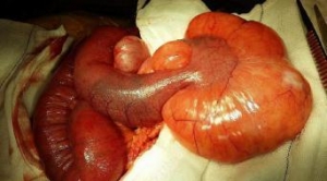 罕见病例：妊娠期腹腔内巨大脂肪瘤