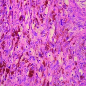 原发性宫颈恶性黑色素瘤一例