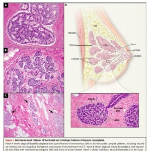 乳腺不典型增生的诊疗规范进展