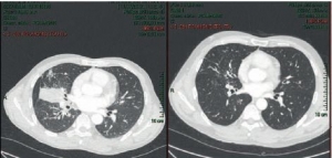 非小细胞肺癌少见突变对靶向治疗反应不同