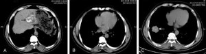 肺内异位胆结石：病例报告及文献综述