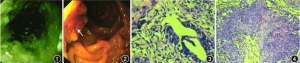 以复发性急性胰腺炎为表现的十二指肠乳头癌合并家族史阳性食管癌一例