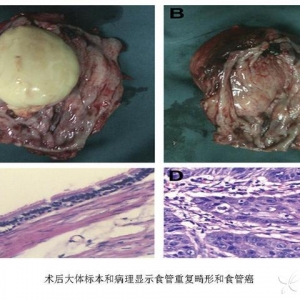 Ann Thorac Surg：西安交通大学第二附属医院王西京教授等报道食管癌合并食管重复畸形  ...