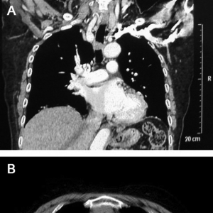 如何更微创：胸腔镜下气管切除重建一例