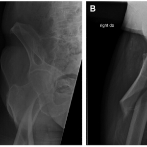 临床综述：股骨转子下骨折诊疗进展
