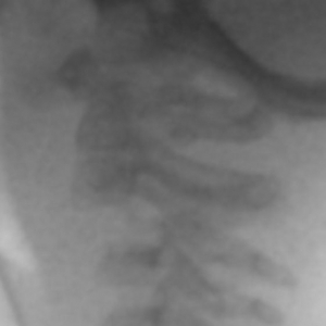 手术技巧：儿童颈椎C2-3骨折脱位复位固定新技术