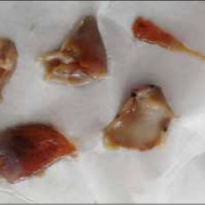 病例学习：复杂性包虫囊肿与&ldquo;空泡&rdquo;征