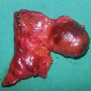 甲状旁腺囊肿引起原发性甲状旁腺功能亢进一例