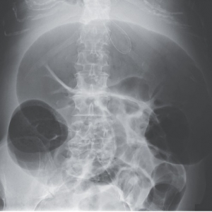 NEJM：急性结肠假性梗阻一例