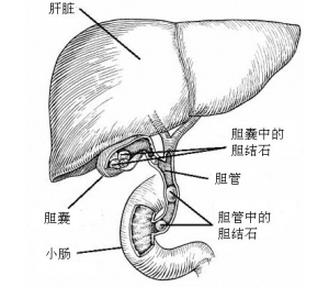 针对解剖困难胆囊行部分切除术更为安全