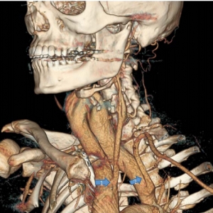 异常生长的颈主动脉弓