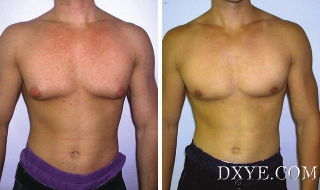 Correction_of_Gynecomastia_in_Body_Builders_and.22 (6).jpg