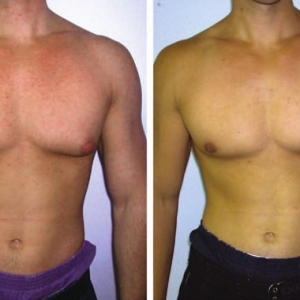 术式选择：健美运动员的男性乳房发育症