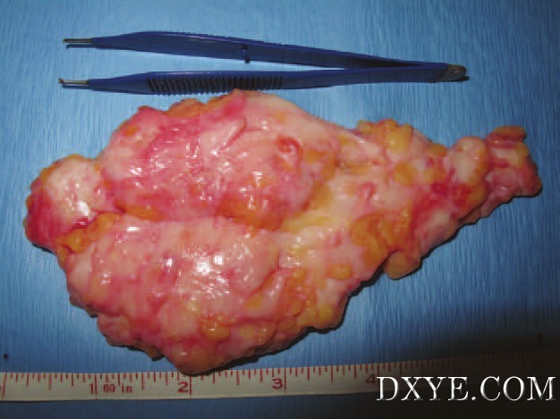 Correction_of_Gynecomastia_in_Body_Builders_and.22 (9).jpg