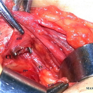 股疝治疗新技术：迷你补片