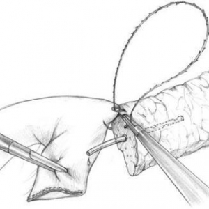 新技术直击：使用倒钩缝合线行腹腔镜胰肠吻合术
