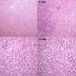 病例学习：脾脏炎性假瘤