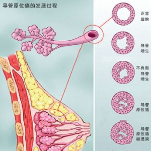 乳腺导管内原位癌不可轻易行单纯切除术