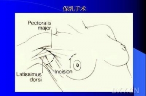 保乳手术切缘阴性仍不能排除残余肿瘤