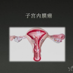 子宫内膜癌诊治进展