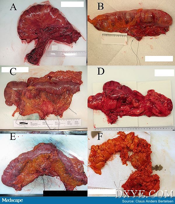 ou_150122_colonic_surgery_600px.jpg