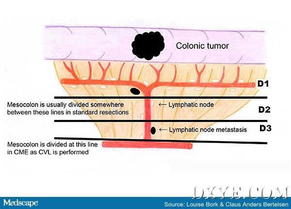 ou_150122_2_colonic_tumor_600px.jpg
