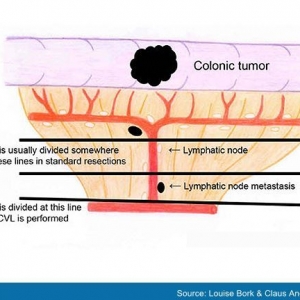 结肠癌手术金标准&mdash;&mdash;全肠系膜切除
