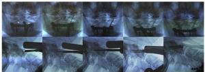 手术技术：前侧咽后入路经关节螺钉经治疗寰枢椎不稳