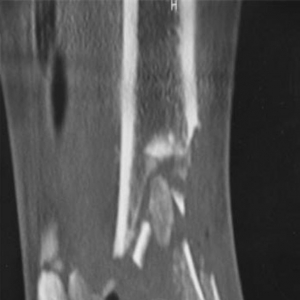 踝关节融合治疗粉碎性Pilon骨折