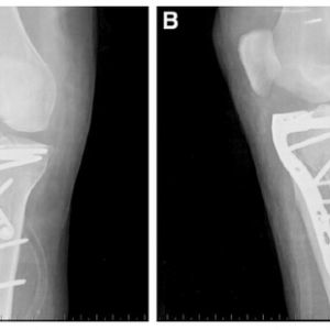 手术技巧：联合入路治疗Schatzker Ⅱ型合并后外侧柱骨折