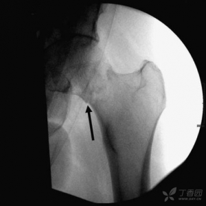 Gotfried法闭合复位不稳定头下型股骨颈骨折的手术技巧