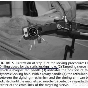 股骨髓内钉远端锁定新技术&mdash;&mdash;磁性瞄准装置的应用