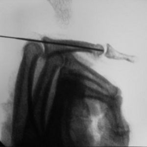 J Hand Surg：闭合复位经皮科氏针固定中节指骨颈部骨折的手术技巧