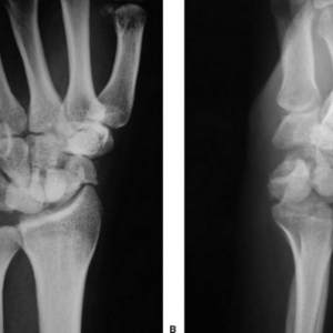 J Hand Surg：切开复位内固定治疗慢性月骨周围损伤的临床效果良好
