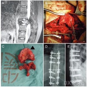 胸腰椎单发转移瘤：前路小切口部分椎体切除vs后路全脊椎切除
