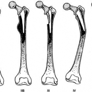AAOS教程：全髋翻修股骨缺损的评估与处理
