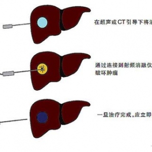 《肝癌局部消融治疗规范专家共识》