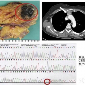 Ann Thorac Surg：胸腺恶性黑色素瘤伴BRCA1基因突变一例