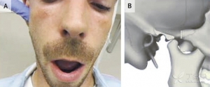 颞下颌关节脱位的复位技巧【视频】