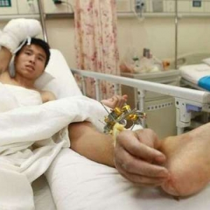 BBC：断手成功寄养至踝关节&mdash;来自中国的医术