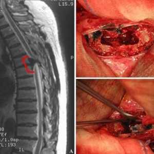 欧洲脊柱：胸廓入路治疗巨大钙化突出胸椎间盘
