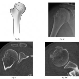 一种新的肱骨大结节骨折形态学分型
