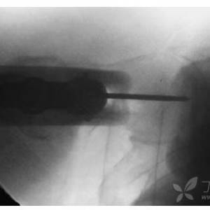 手术技巧：股骨近端髓内钉的置入方法