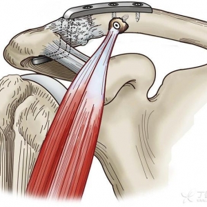喙突移位联合钩钢板治疗肩锁关节脱位