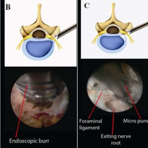 Neurosurgery：椎间孔镜微创治疗骨性椎间孔狭窄