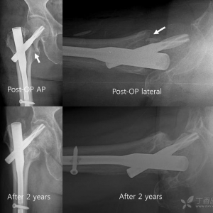 Injury手术技巧：股骨转子间骨折骨钩撬拨复位技术