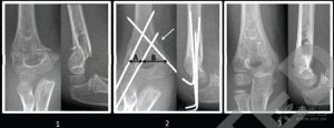 内侧克氏针固定治疗儿童髁上骨折安全有效