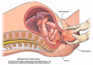手术助产阴道分娩中的肩难产的预测