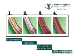 FDA 建议应慎重权衡雅培溶解型支架 Absorb 的风险